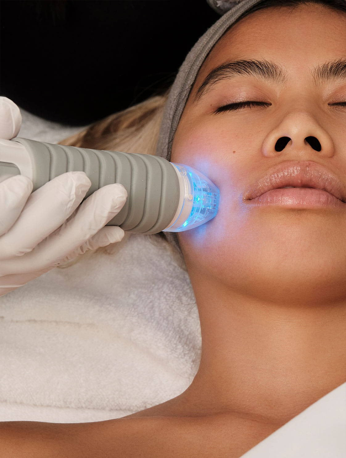 Vivace RF Microneedling