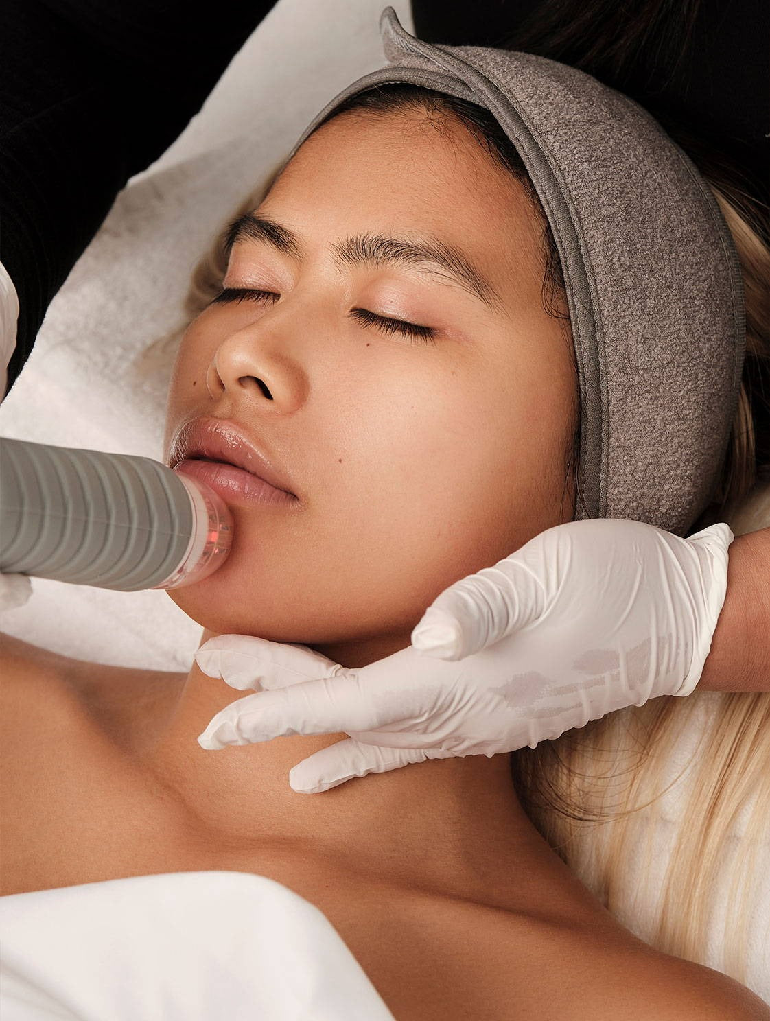 Vivace RF Microneedling