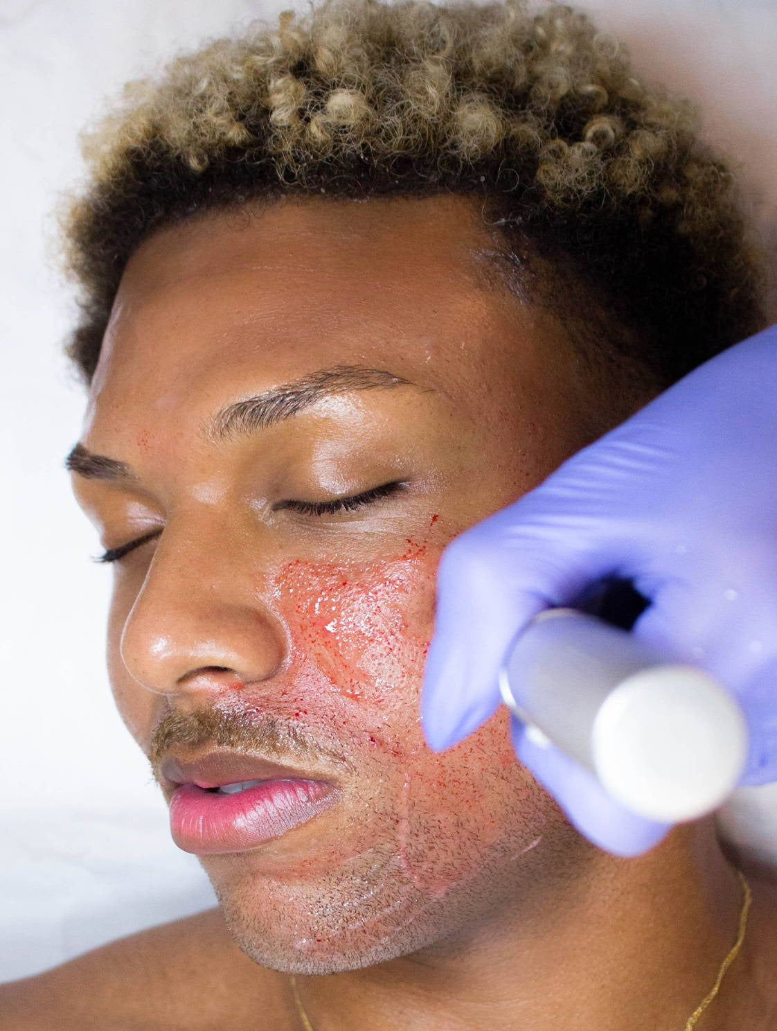 Microneedling