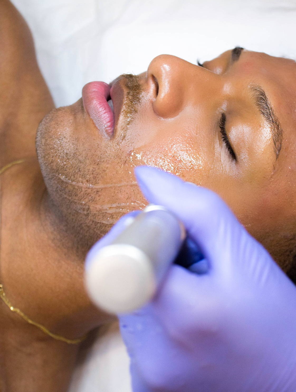 Microneedling