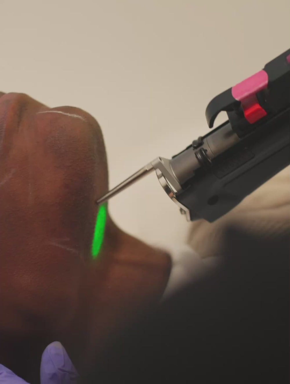 Laser Hair Removal at Erase Spa | Safe, Effective, and Long-Lasting